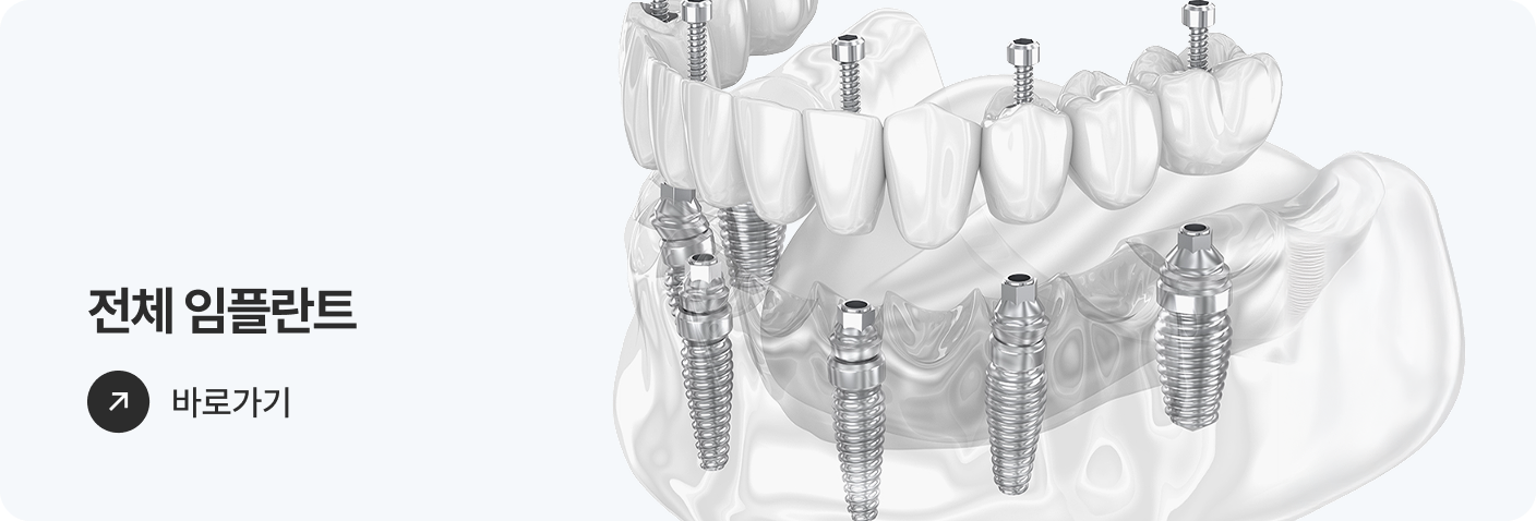 전체 임플란트